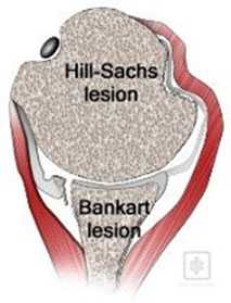 Лечение вывиха плечевого сустава