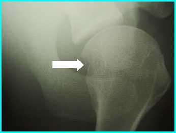 Лечение вывиха плечевого сустава