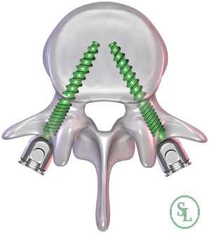 Виды спондилодеза