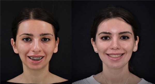 Остеотомия верхней и нижней челюсти: до и после