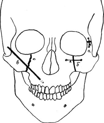 Схематическое изображение фиксации спиц Киршнера