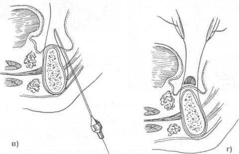 Окружающий шов
