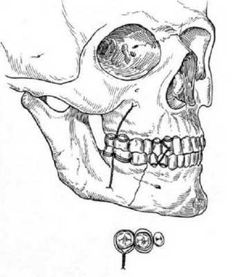 Метод Адамса