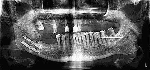 Остеосинтез мини-пластинами