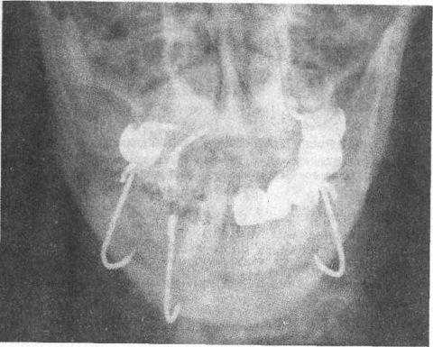 Унифицированные крючки