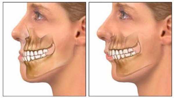 Ортогнатическая операция стоимость