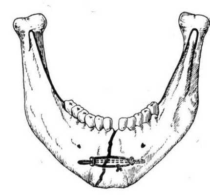 Остеосинтез нижней челюсти при переломе со смещением костных фрагментов