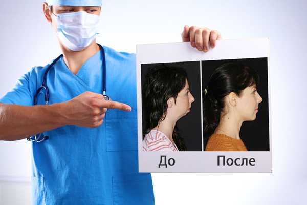 Ортогнатические операции фото до и после