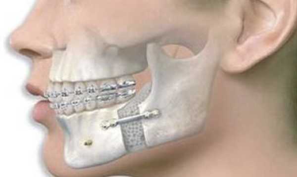 Порядок проведения ортогнатической оппперации