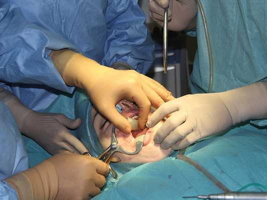 Ортогнатическая операция до и после