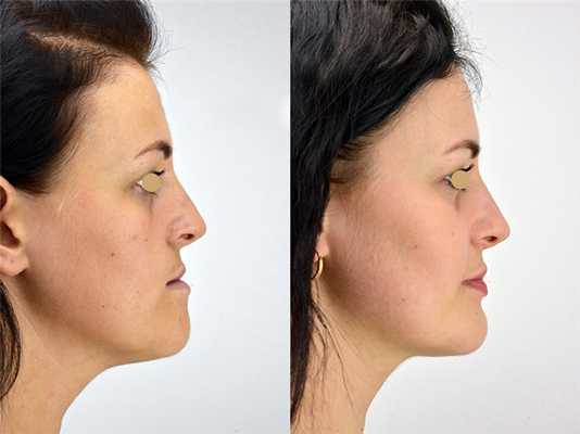 До и после остеотомии