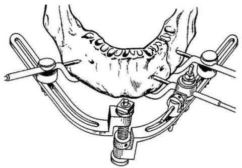 Динамический аппарат