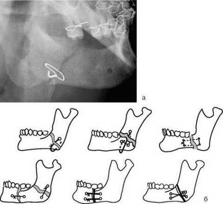Остеосинтез с помощью костного шва