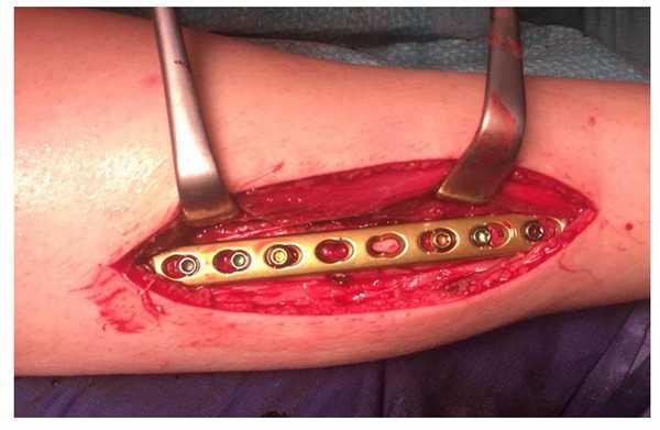 остеосинтез локтевой кости пластиной и винтами