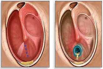 Тимпаностомия
