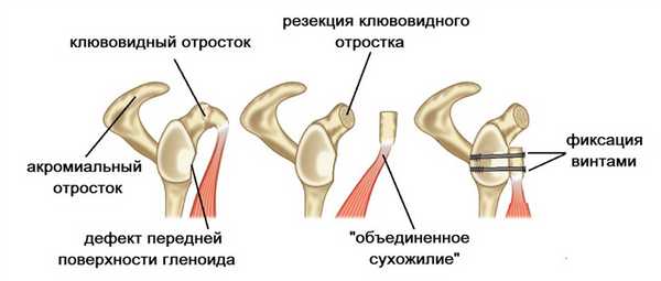 операция латерже