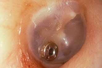 Тимпаностомия у взрослых