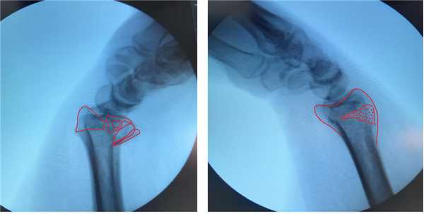 рентген с функциональными пробами перелом луча