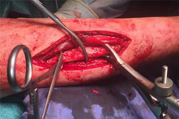 перелом локтевой кости операция