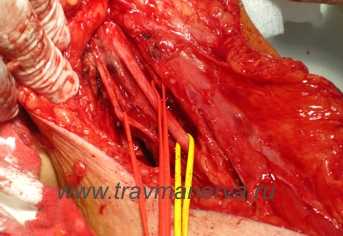 Этапы операции реиннервации мышечно-кожного нерва добавочным с использованием аутотрансплатата