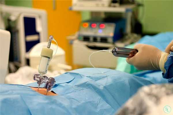 Кифопластика