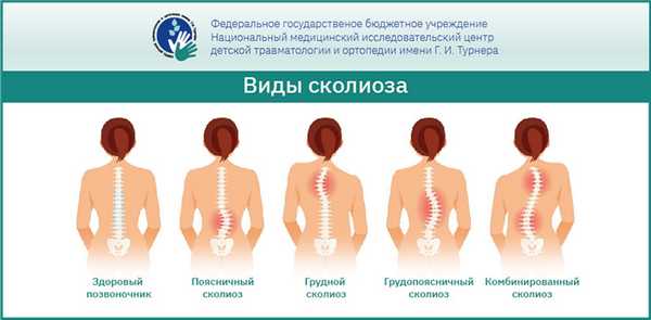 Идиопатический сколиоз — причины, виды, методы диагностики и лечения