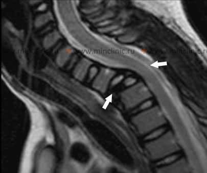 При МРТ шейного отдела позвоночника на изображении с боку можно увидеть смещение тела C7 позвонка и перелом тела Th1, образующее сдавление спинного мозга на этом уровне после травмы (указаны стрелками).