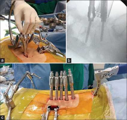 Шейный спондилез