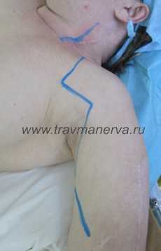 Хирургический доступ для реиннервации плечевого сплетения