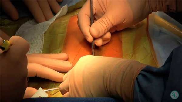 Операция при сколиозе