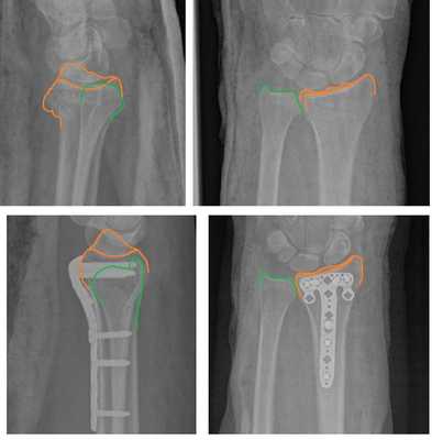 положение суставной фасетки при переломе лучевой кости
