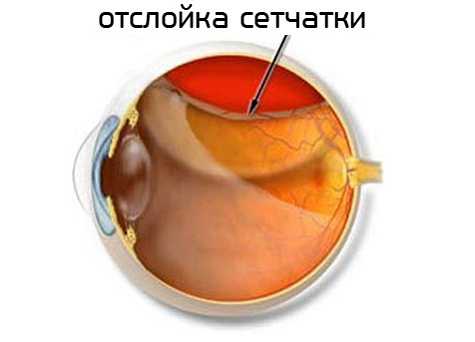 Когда и как лечится отслоение сетчатки