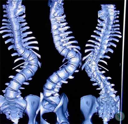 Искривление 