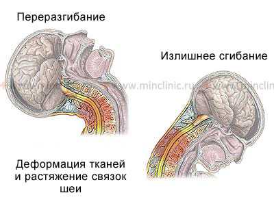 Чрезмерное разгибание или сгибание при травме шеи может сместить шейные позвонки и сформировать вывих.