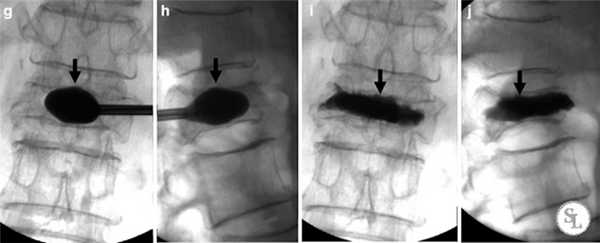 рентген до и после операции