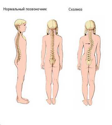 Сколиоз