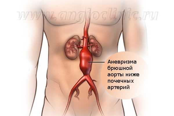 Аневризма брюшной аорты