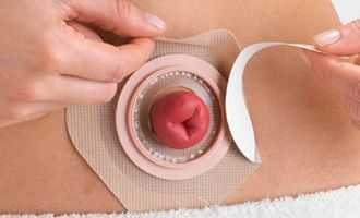 Закрытие колостомы - реконструктивная колопластика