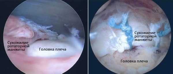 Операции на плече