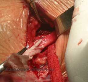 Измененный верхний первичный ствол плечевого сплетения