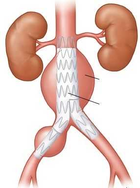 Эндопротезирование аневризмы - оптимальный и безопасный метод лечения