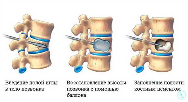 Что такое кифопластика