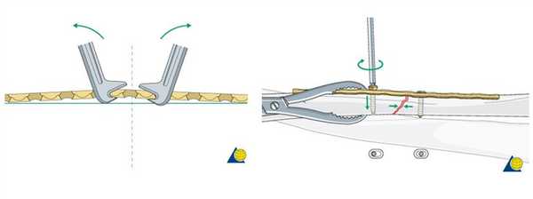 остеосинтез пластиной