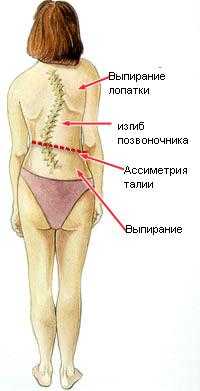 Лечение сколиоза