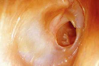 Осложнения