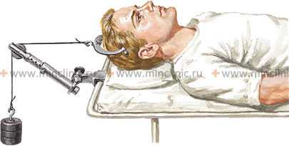 Скоба Гарднера-Уэллса применяется при неотложной помощи; вытяжение шеи по длине осуществляется через регулируемый блок, закреплённый к прозрачному для рентгеновских лучей столу.