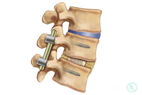 Особенности реабилитации после спондилодеза