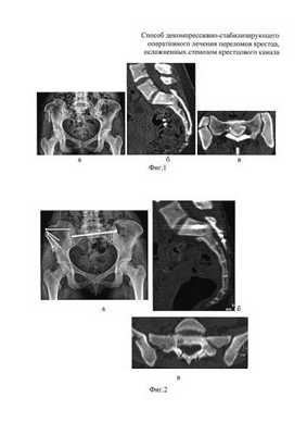 Способ декомпрессивно-стабилизирующего оперативного лечения переломов крестца, осложненных стенозом крестцового канала