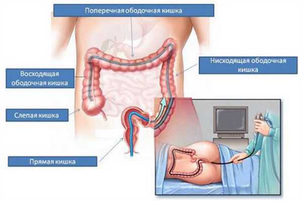 Какой кишечник проверяет колоноскопия