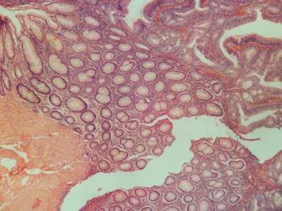 Описание: слайд 10 тубуло-ворс аденома, микро